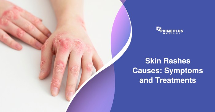Remedies rashes rid effective Remedies rashes rid effective
