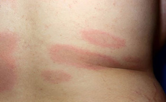 How to Diagnose 7 Skin Rashes at Home